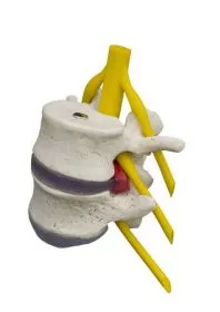 Lendenwirbelsule Hernie-Modell A208.1
